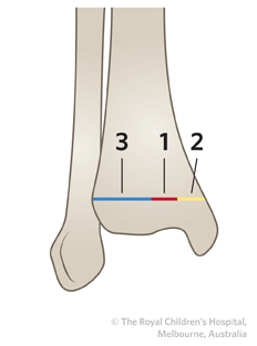 Figure 1 TIBIAL PHYSIS CLOSURE